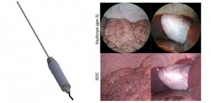 Low-cost laparoscope, called the KeyScope left computer-aided design rendering enables high resolution surgical imaging with a wide field of view, color accuracy, and low distortion, resulting in comparable images to a standard SOC laparoscopic device rig